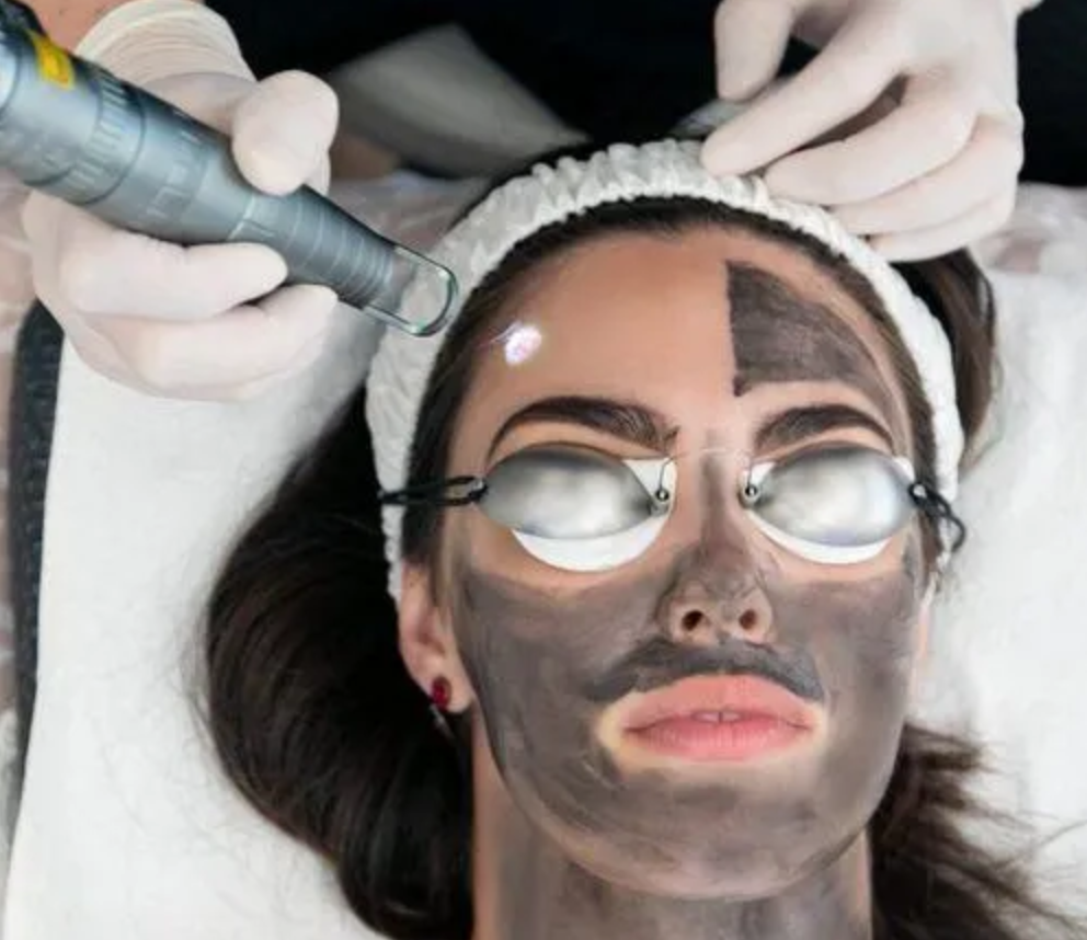 Hollywood-Laser-Peel-West-Bloomfield-Township-MI
